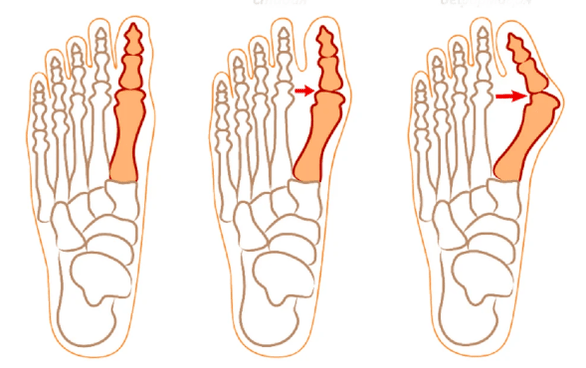 Deformidad hallux valgus