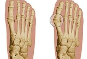 causas del hallux valgus