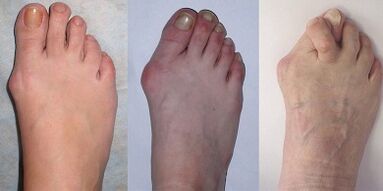 etapas del hallux valgus