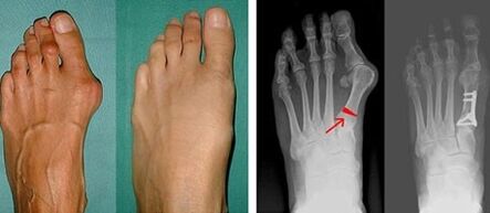 síntomas del hallux valgus