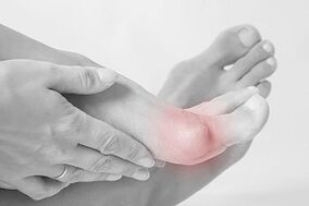 Hallux valgus cómo elegir los zapatos
