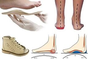 zapatos ortopédicos para hallux valgus en un niño