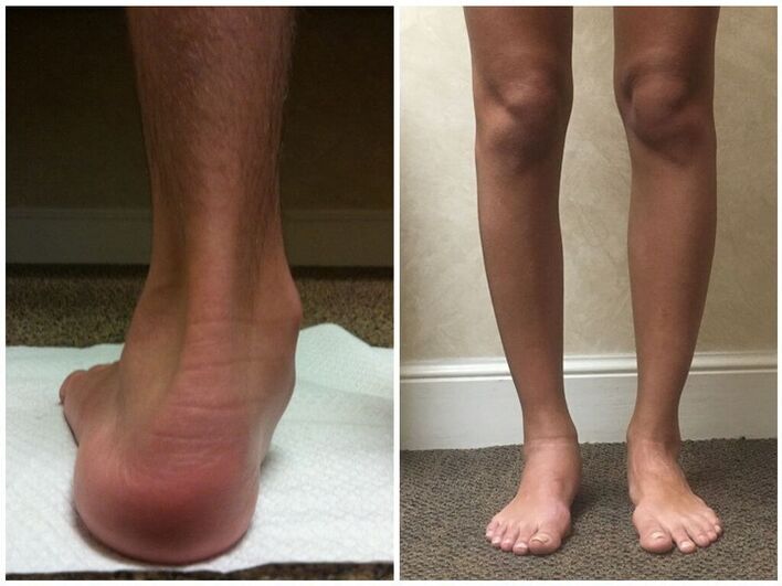 Piernas con hallux valgus