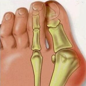 Las razones de Valgus