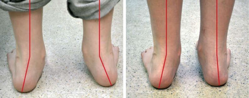 Patas de valgo