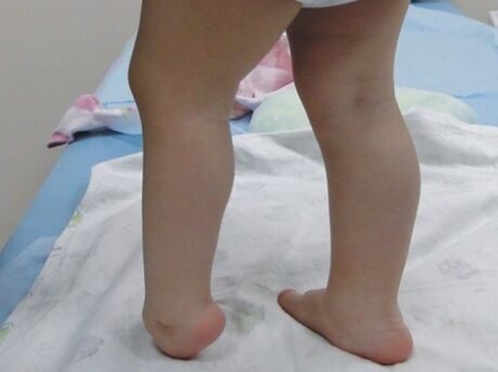 Los primeros síntomas de la deformación del valgo del pie