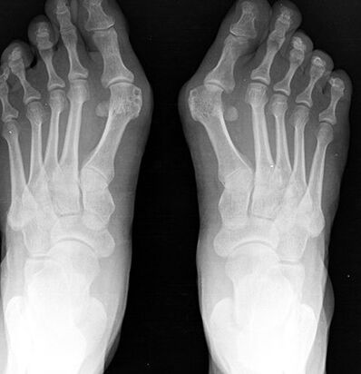 X -ray del pie